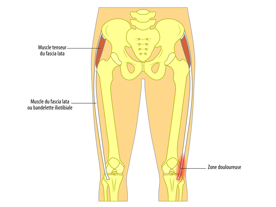 Tendinite du genou : fascia lata (syndrome essuie-glace)
