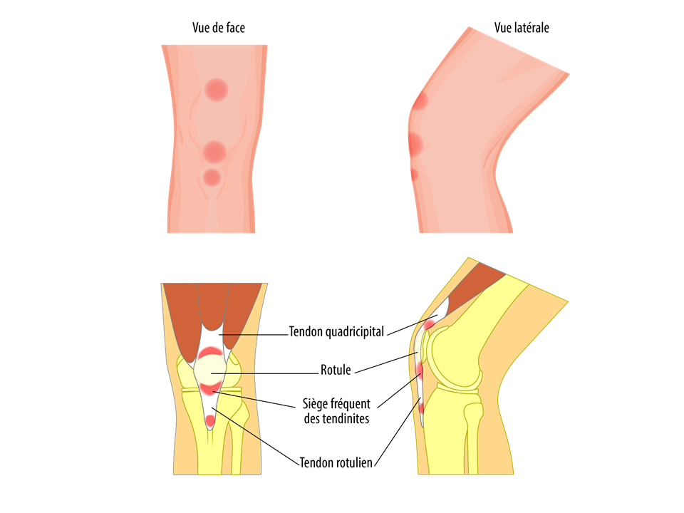 Tendinite du genou : rotulienne