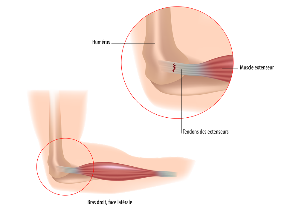 Tendinite : coude (épicondylite latérale ou tennis-elbow)