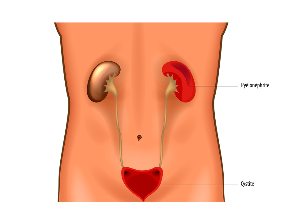 Infection urinaire : cystite, pyélonéphrite - illustrations ...