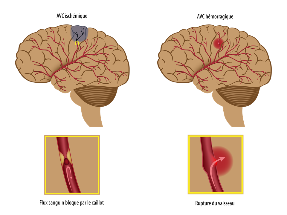 Qué enfermedades se pueden detectar con un tac cerebral